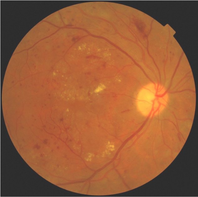 Hemorragias retinianas