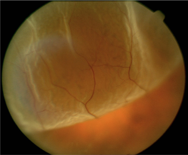 Desprendimiento de retina